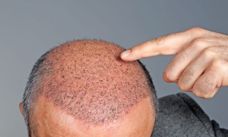 عملية زراعة شعر في الهند تسبب تعفن الدم .. أغرب وفاة