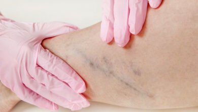الجلطة الدموية الخطيرة .. علامتان في الساق تنذران بوقوعها