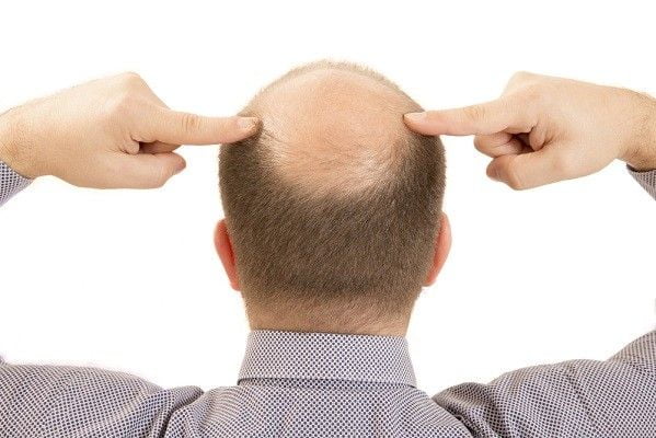 مشكلة تساقط الشعر