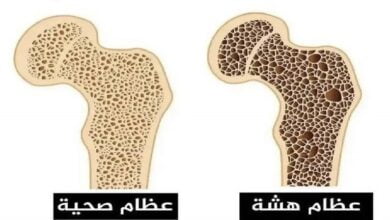 هشاشة العظام