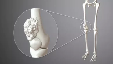 ما أعراض سرطان العظام وأسبابه؟