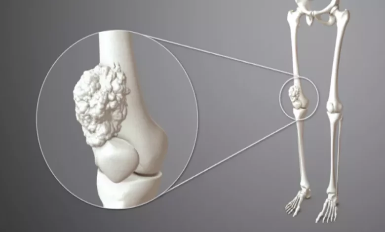 ما أعراض سرطان العظام وأسبابه؟